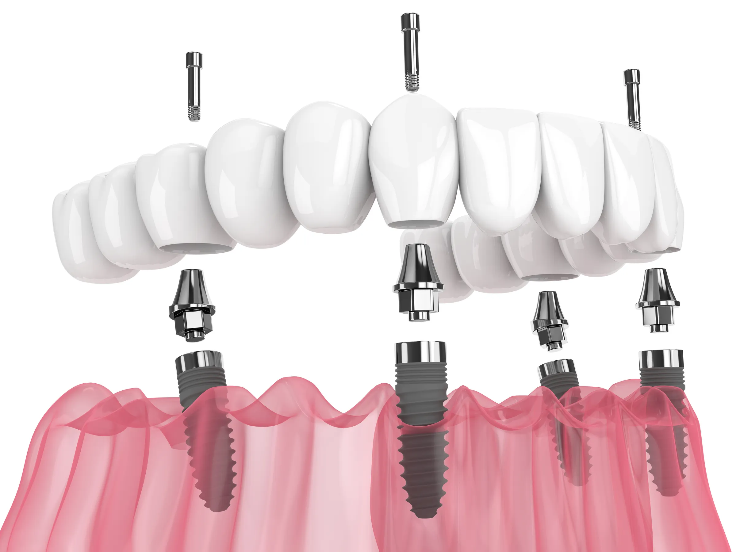 Illustration of a full-arch bridge being attached to four dental implants
