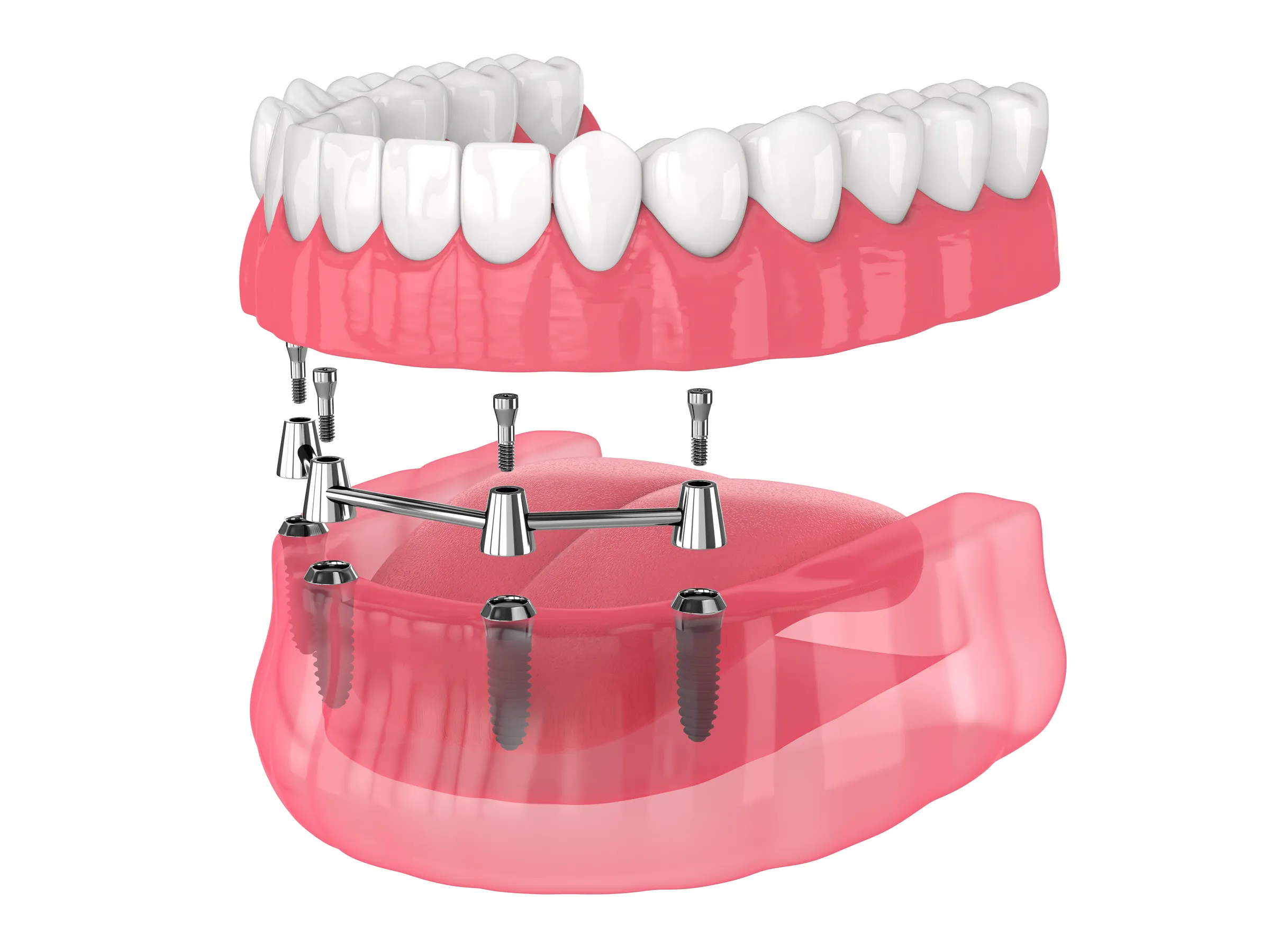 Illustration of a full denture fitted onto a bar supported by dental implants