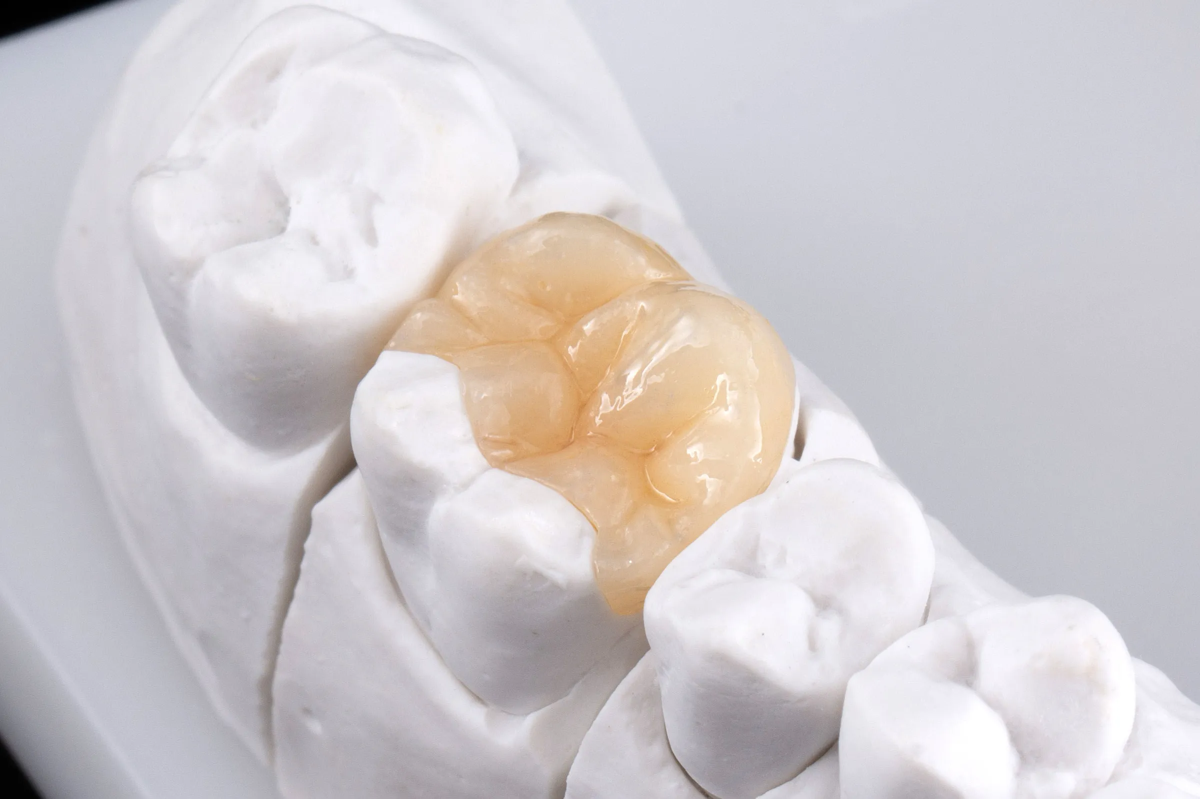 Tooth-colored onlay on a molar in a stone model