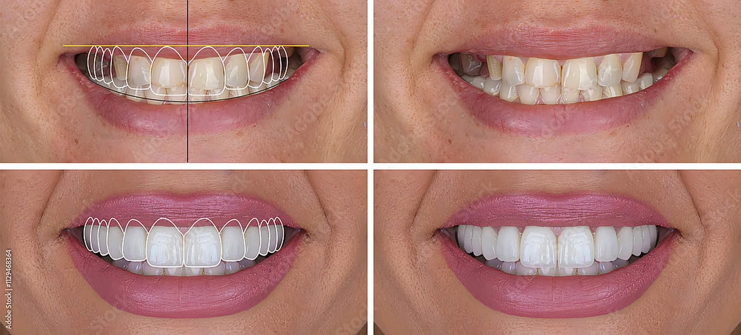 Four-panel comparison of a smile before and after a smile makeover