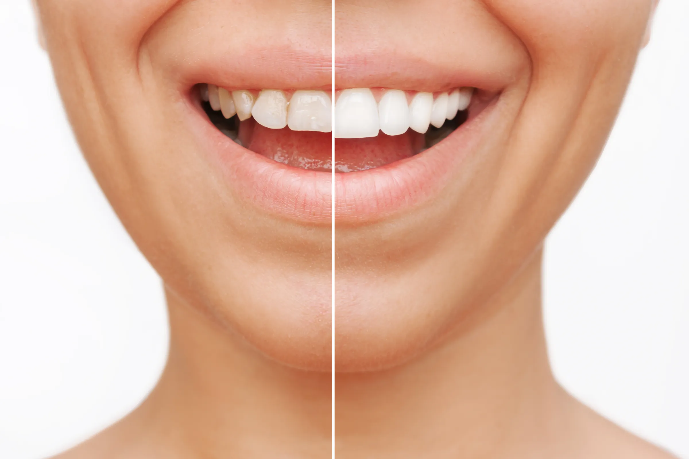 Split view of a smile before and after veneers
