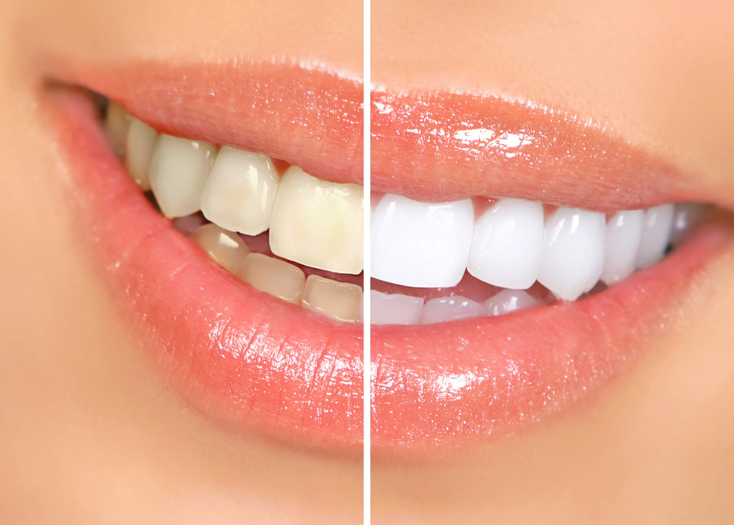 Split view of a smile before and after teeth whitening