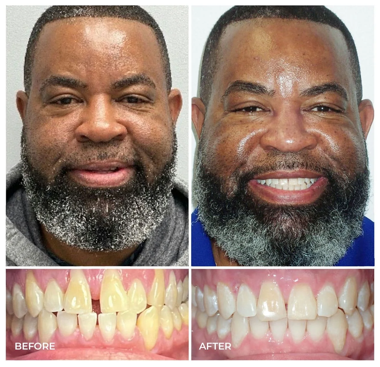 Before and after alignment treatment