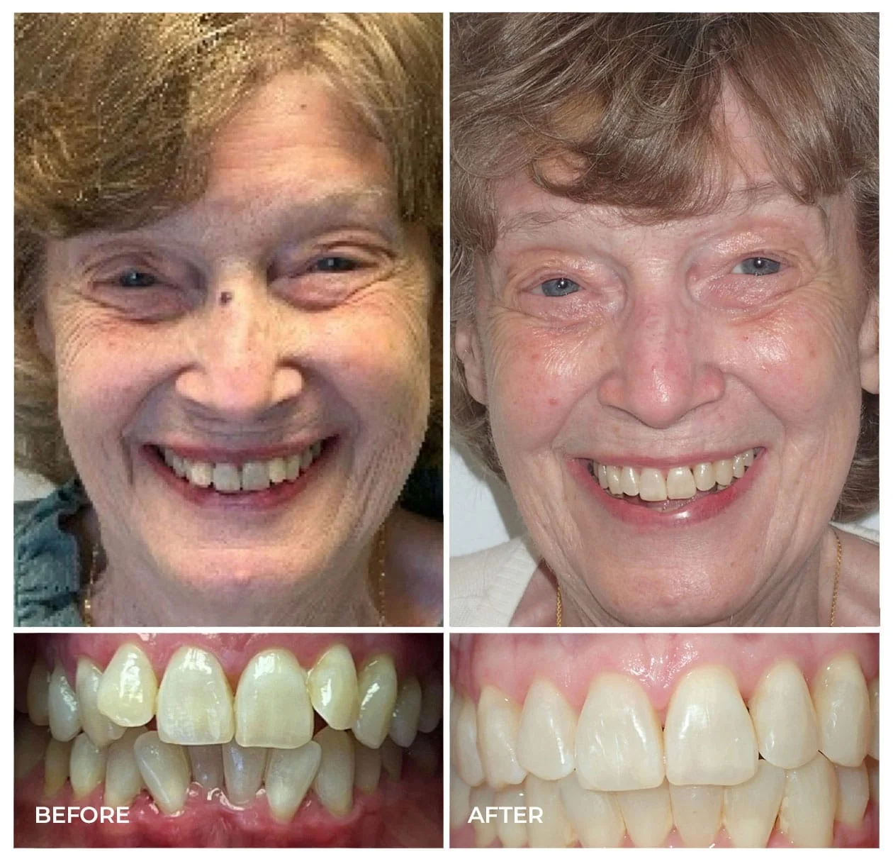 Before and after Invisalign treatment