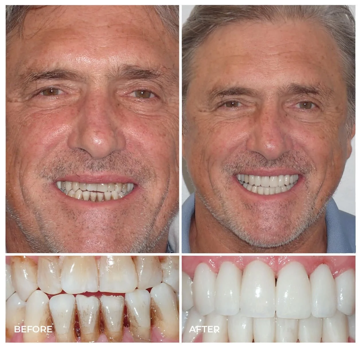 Before and after restorative treatment