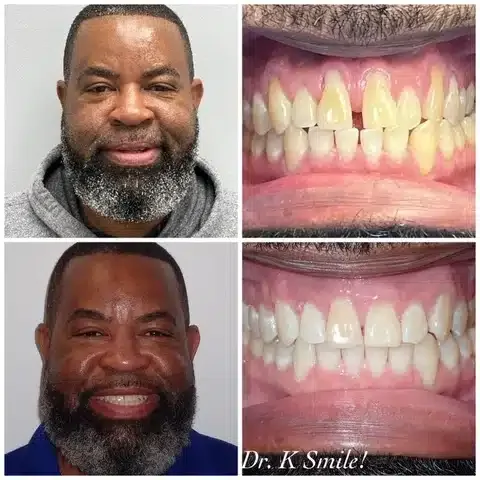 Invisalign before and after
