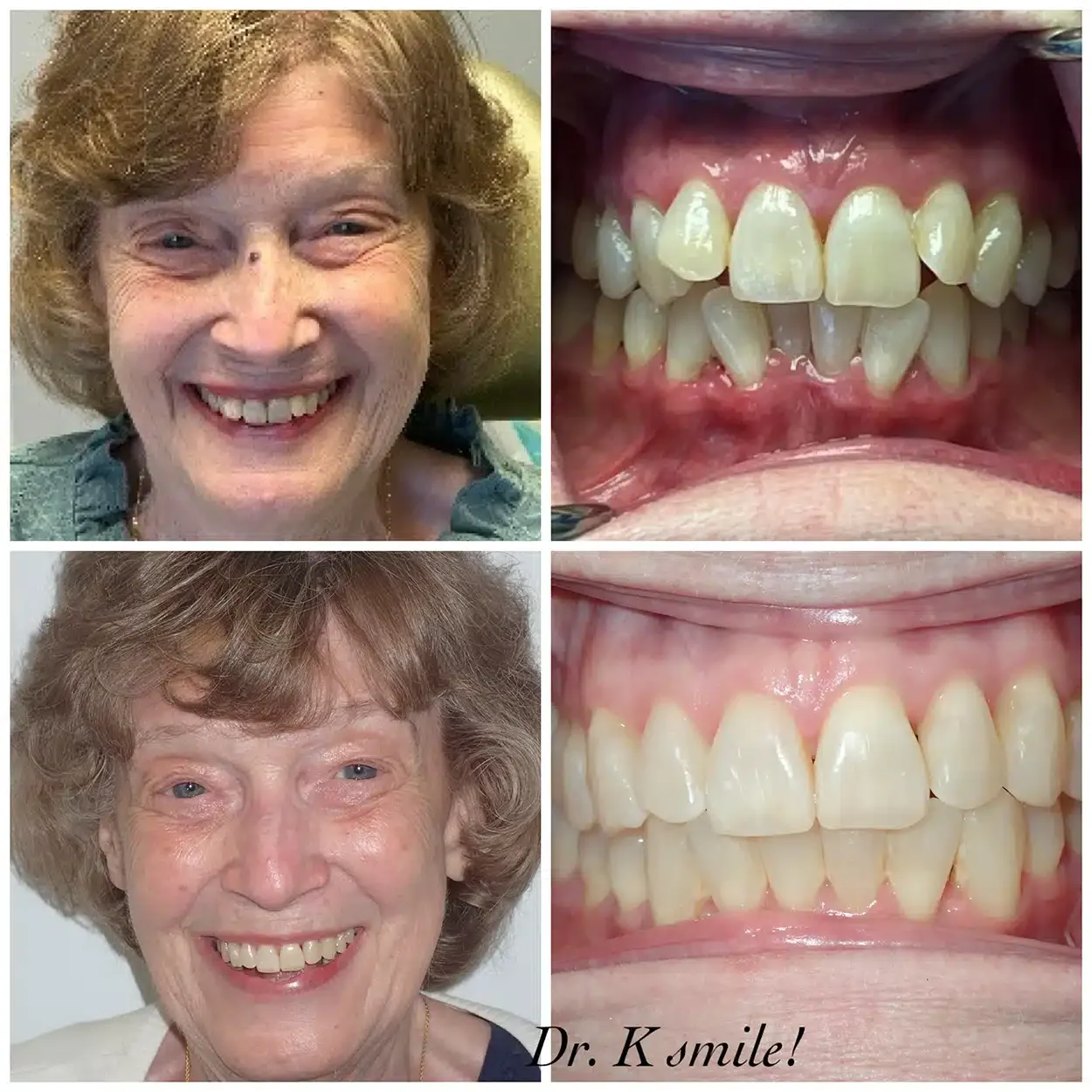 Invisalign before and after