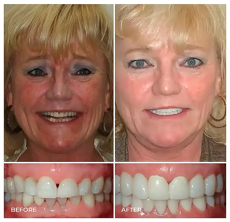 reston heights smile gallery 03