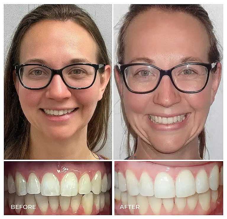reston heights smile gallery 07