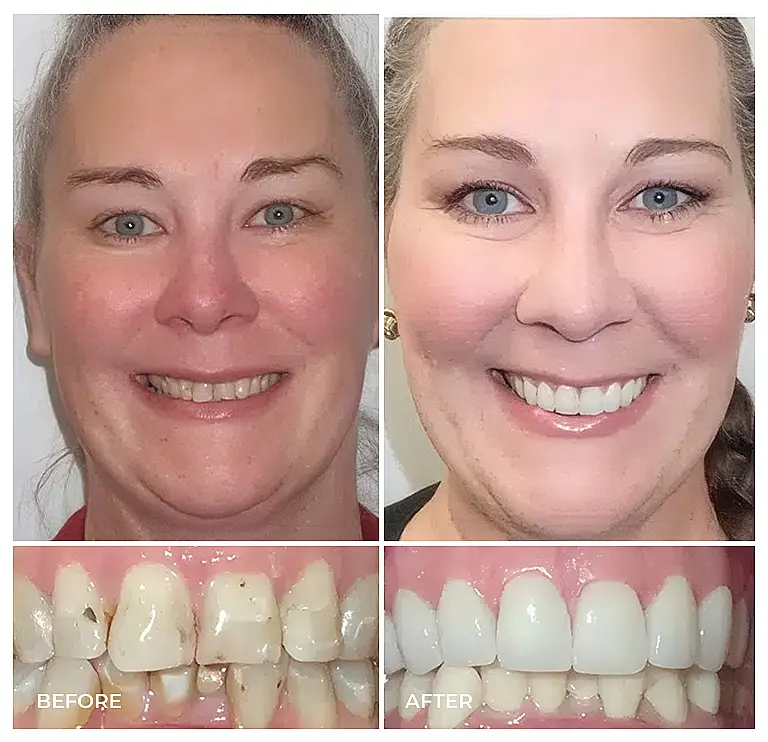 reston heights smile gallery 12