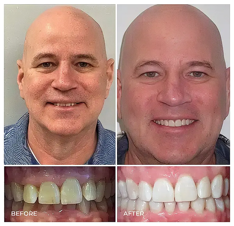 reston heights smile gallery 13