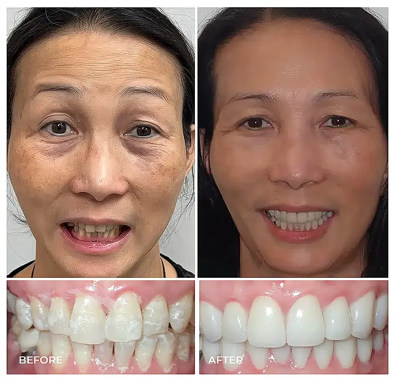 reston heights smile gallery 19