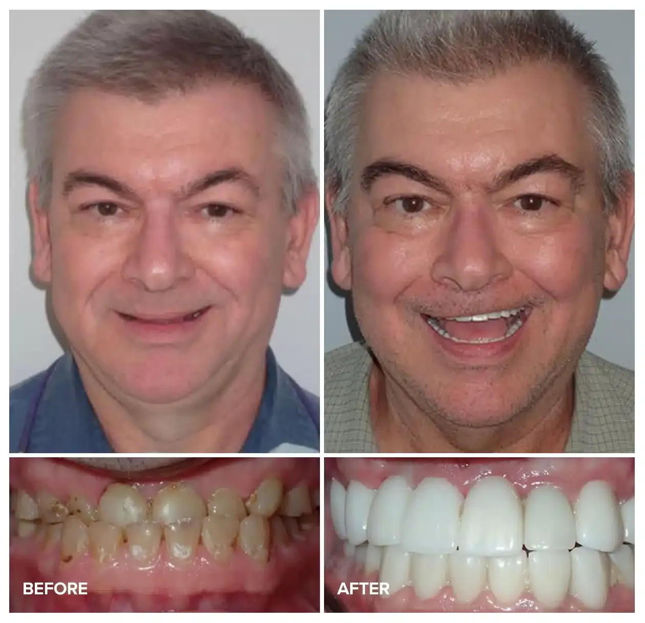 Before and after smile makeover