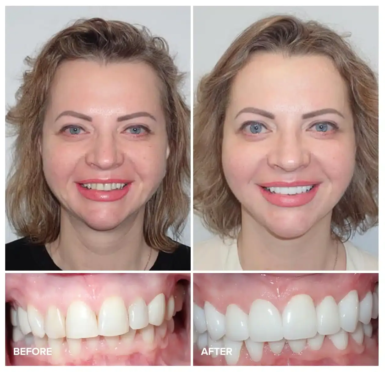 Before and after full-mouth treatment