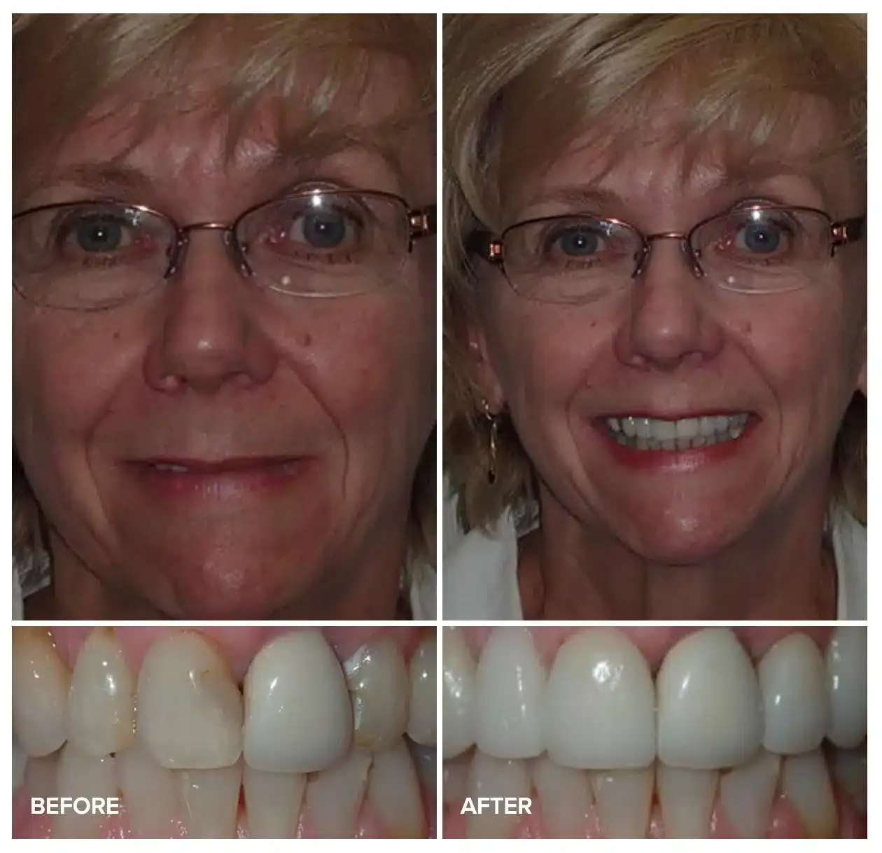 Before and after smile makeover